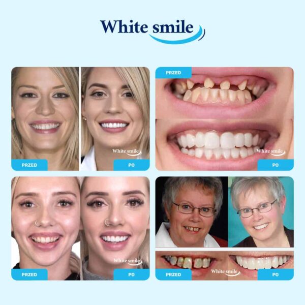 Alternative view of WHITESMILE™ – Regulowana Kosmetyczna Nakładka Dentystyczna